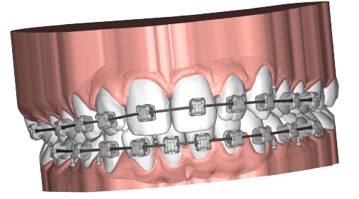 Logiciel de fabrication de brackets avec Nativitas Médical